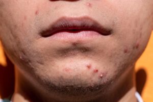 Lichttherapie gegen Akne arbeitet mit sichtbarem Licht und erzielt gute Erfolge